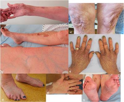 Case report: Two individuals with AEBP1-related classical-like EDS: Further clinical characterisation and description of novel AEBP1 variants